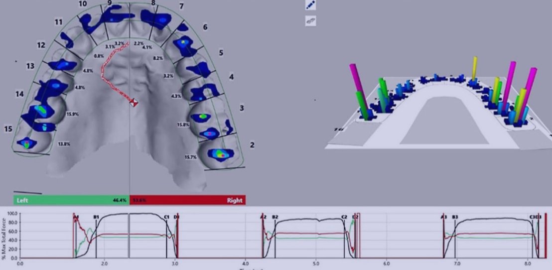 Digital Occlusal Analysis