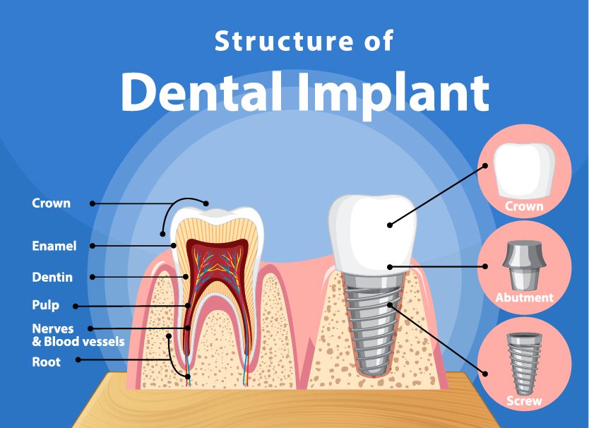 dental implant