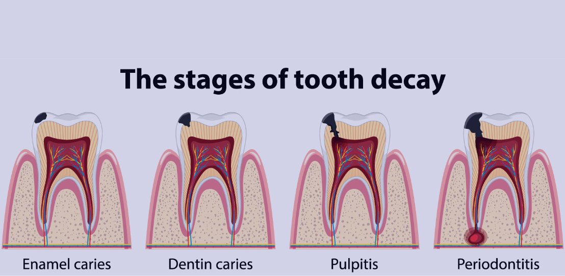 ROOT CANAL THERAPY