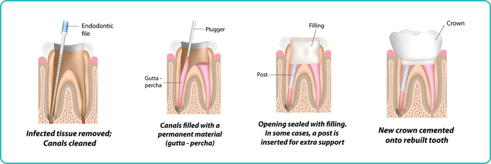 Root Canal Procedure