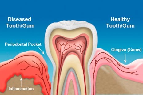 How can I tell if I have periodontitis gum disease?