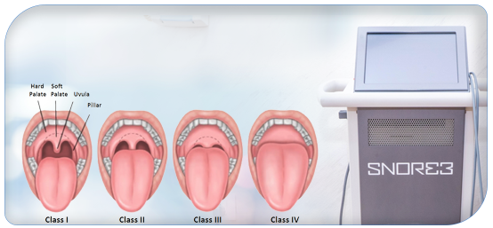 Snoring Solution