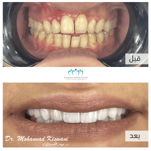 After Before Treatment ابتسامة هوليوود