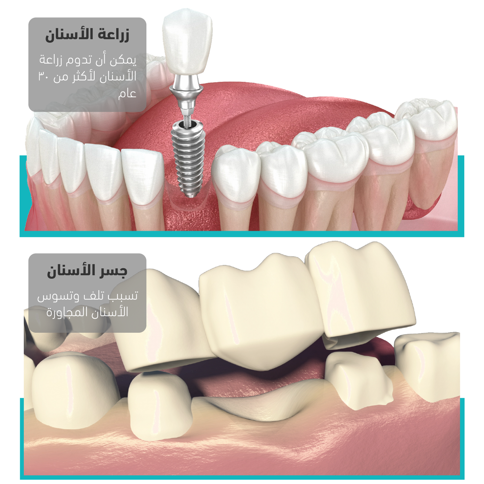 الزرعات السنية والجسور Dental Implants or a Bridge?