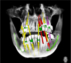 زراعة الأسنان الموجهة بالحاسوب