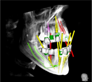 زراعة الأسنان الموجهة بالحاسوب