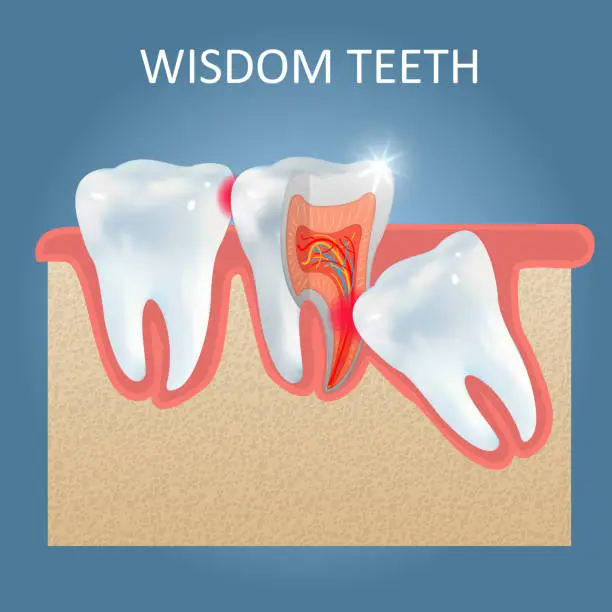 أضراس العقل Wisdom Teeth