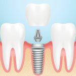 زراعة الأسنان الفورية Can a dental implant be placed at the same visit as the teeth are extracted?