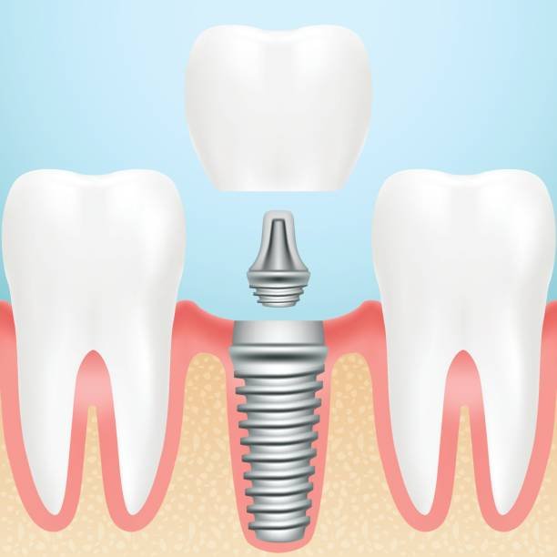 Can a dental implant be placed at the same visit as the teeth are extracted?