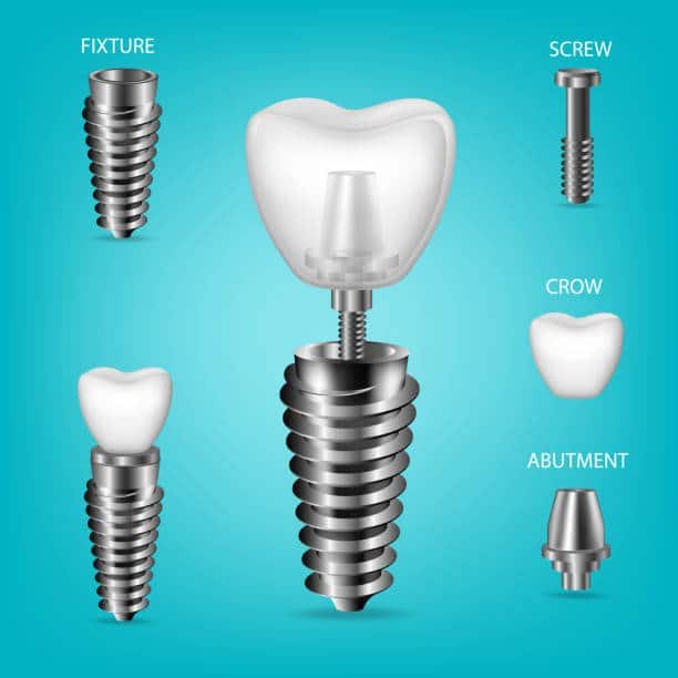 زراعة الأسنان بدقة في المركز الأوروبي لطب الأسنان Best Dental Implant Doctor In Jordan