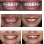 Crown Lengthening and Gummy Smile Reduction treat a gummy smile problem