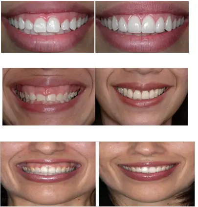 Crown Lengthening and Gummy Smile Reduction treat a gummy smile problem