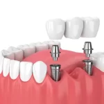 Crown or Bridge! Best Types of Dental Prosthesis