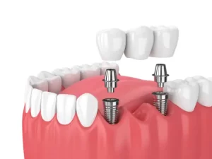 Crown or Bridge! Best Types of Dental Prosthesis