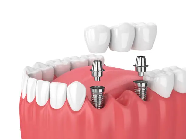 Crown or Bridge! Best Types of Dental Prosthesis الجسر وزراعة الأسنان