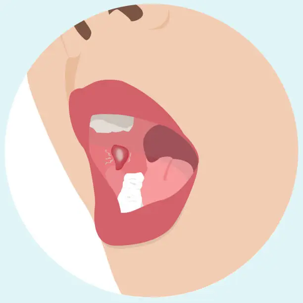 Mouth Ulcer