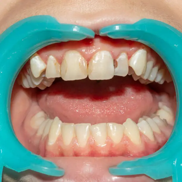 What is dental fluorosis?