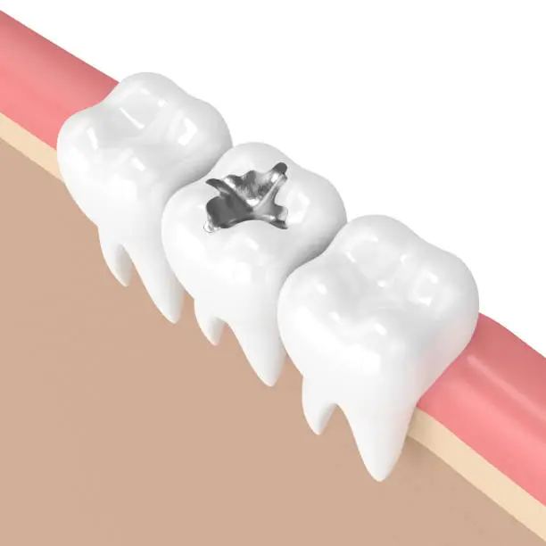 Should I replace my silver fillings with white fillings?