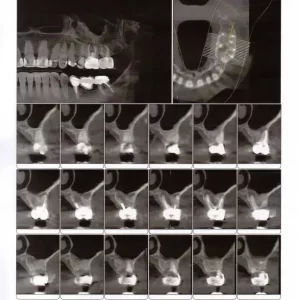 أشعة الأسنان من أساليب طب الأسنان الوقائي