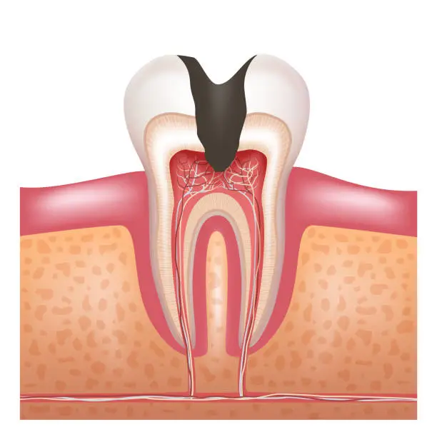 Advises for prevention of dental caries