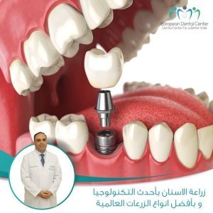 Best Dental Implant Doctor In Jordan