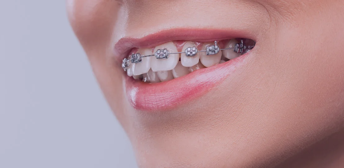Orthodontic Treatment
