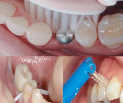 طريقة تنظيف زرعات الأسنان لضمان نجاح زراعة الأسنان.