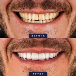 Before After Teeth Comparison