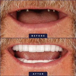 ميزات زراعة الأسنان؛ أسنان مشابهة للأسنان الطبيعية denture won't slip