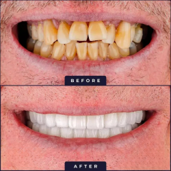 القشور الخزفية VENEERS